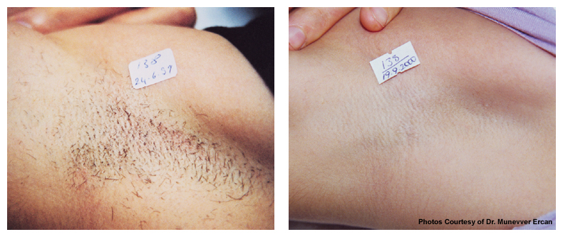 Laser Hair Removal | Body 'N' Bloom | Pre & Post Treatment Guidelines